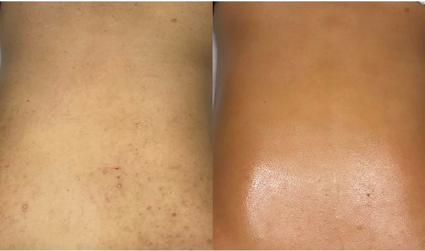 Before and after Clarifying Back Facial at Ora Medical Spa