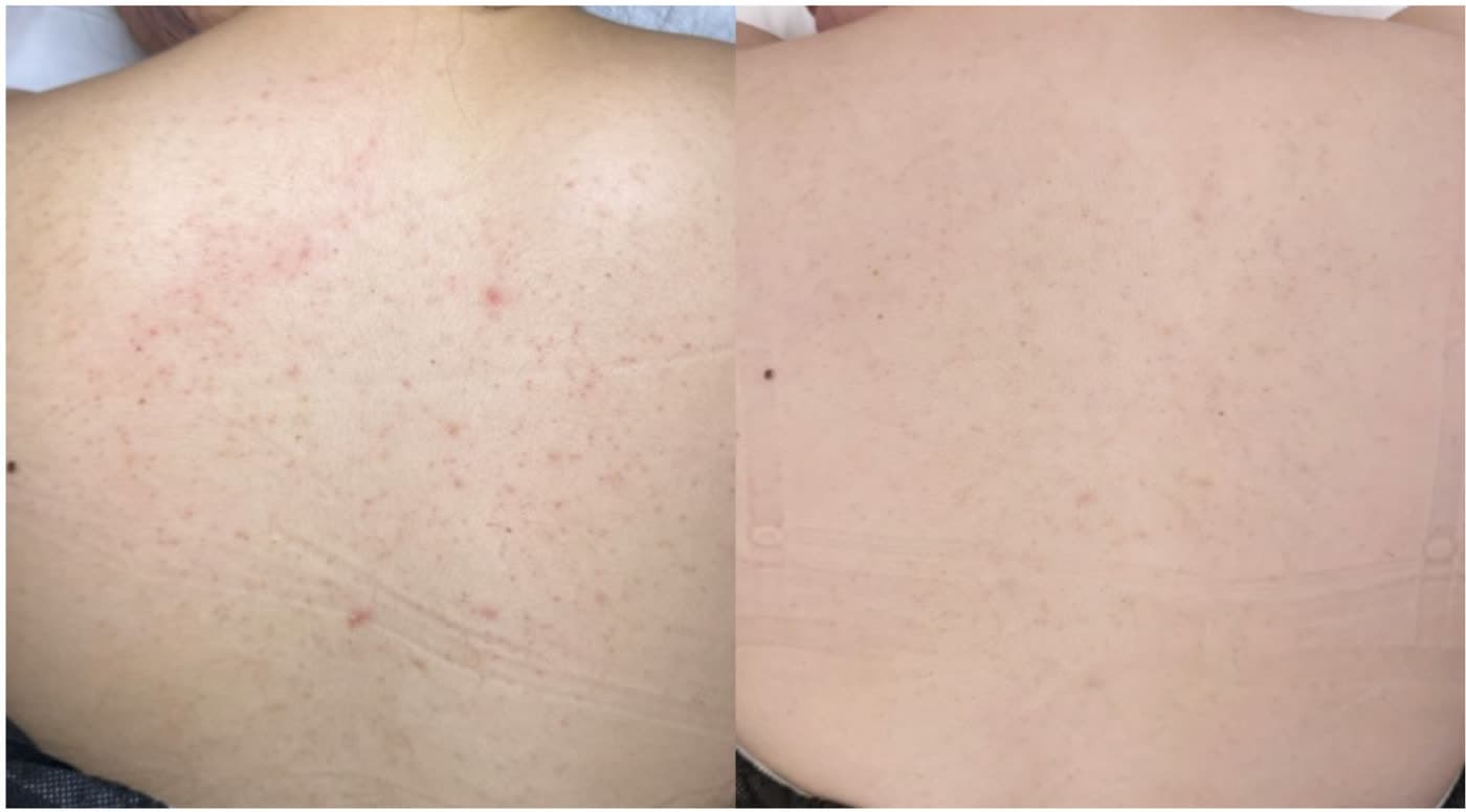 Before and after Clarifying Back Facial at Ora Medical Spa
