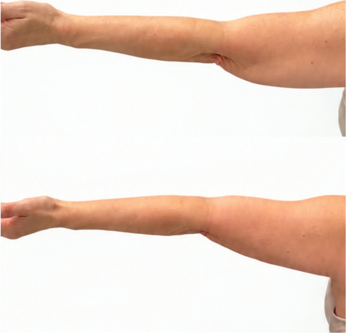 Before and after Cold Sculpting Fat Reduction at Ora Medical Spa