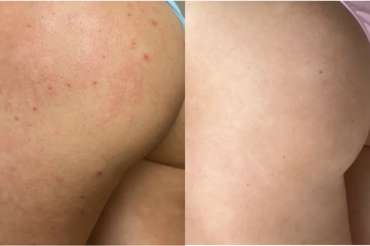 Before and after HydraBooty Treatment at Ora Medical Spa