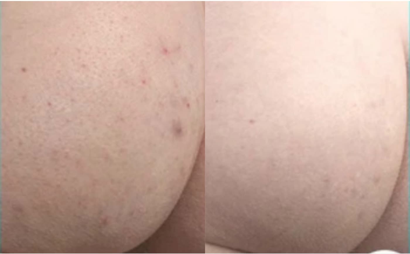 Before and after HydraBooty Treatment at Ora Medical Spa