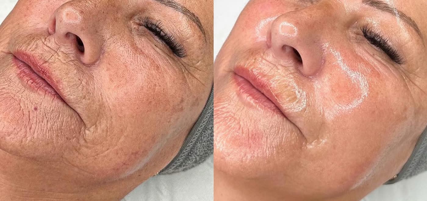 Before and after a HydraFacial at Ora Medical Spa