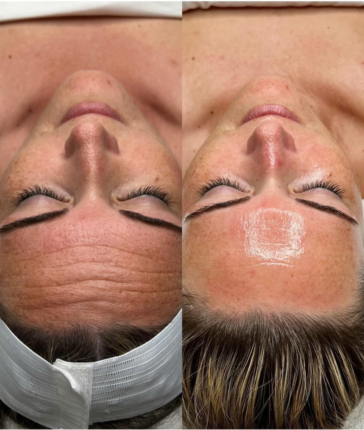 Before and after a HydraFacial at Ora Medical Spa