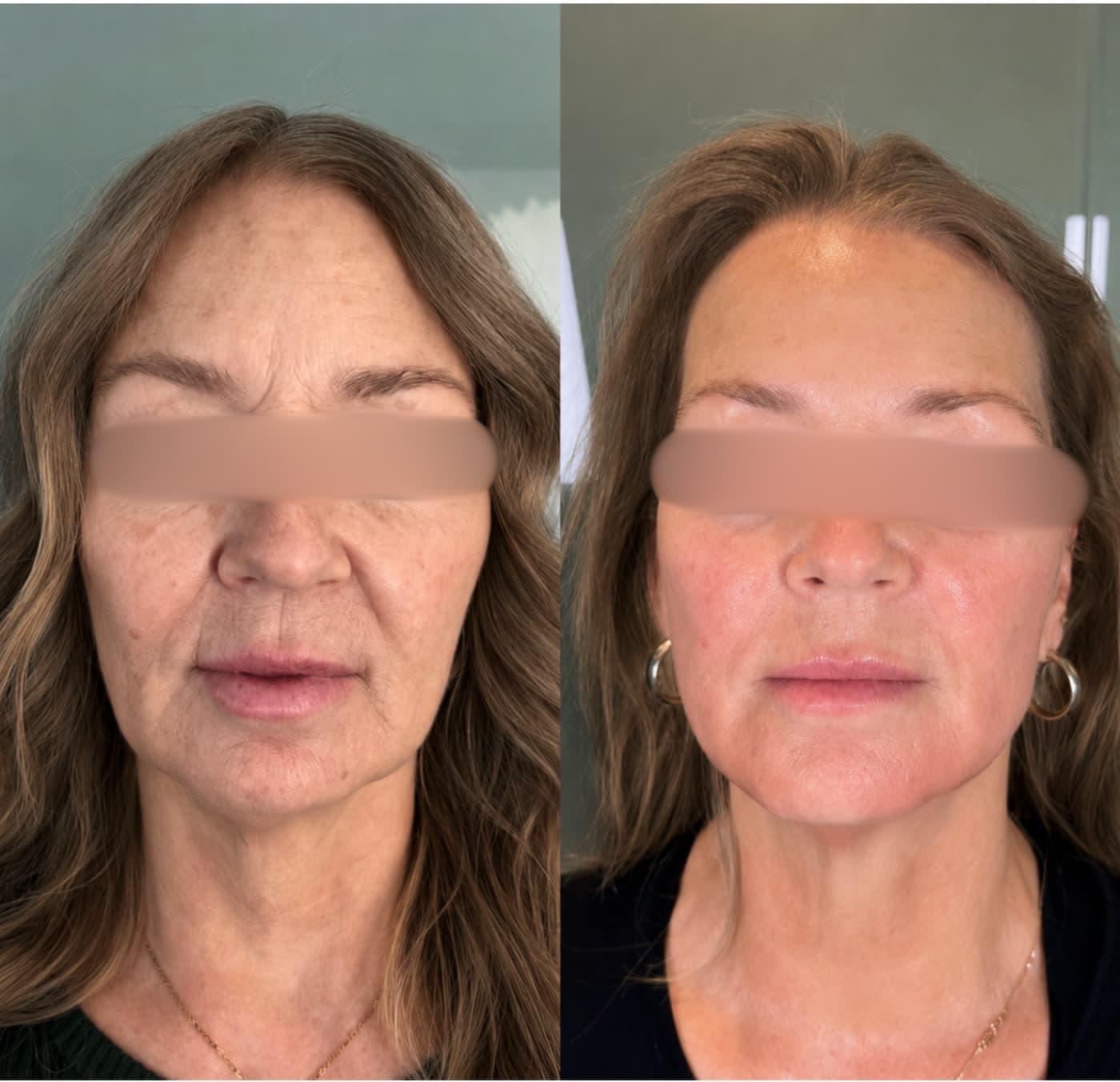 Before and after LED Age-Defying Facial at Ora Medical Spa
