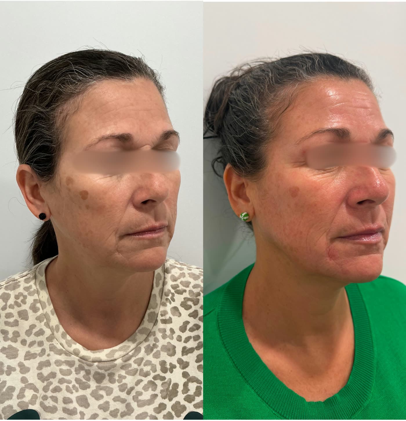 Before and after Microneedling Skin Renewal at Ora Medical Spa