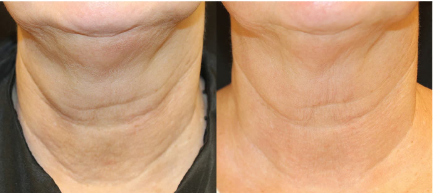 Before and after Opus Plasma Skin Resurfacing at Ora Medical Spa