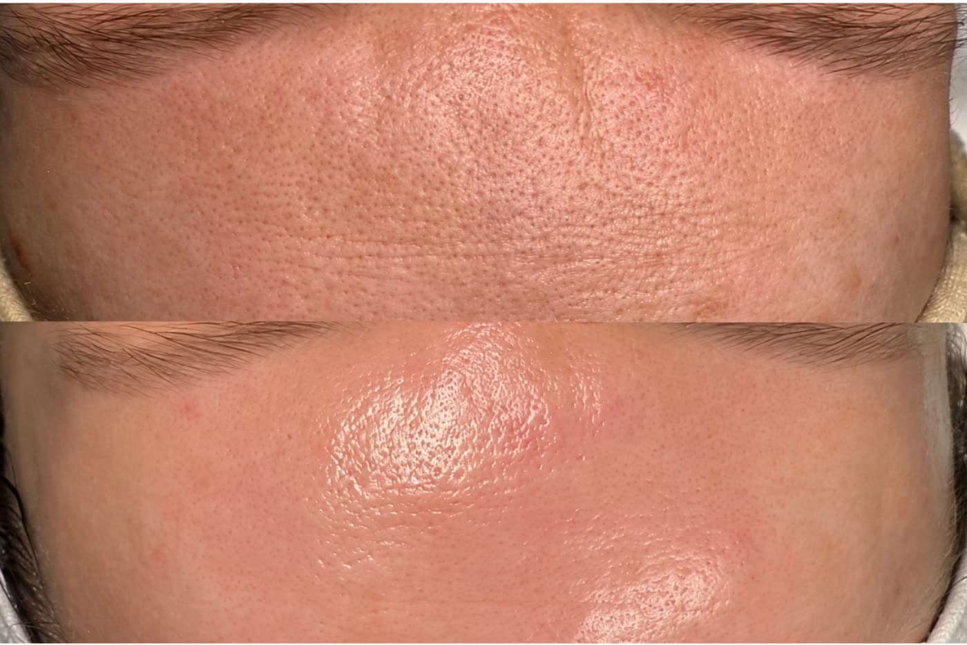 Before and after Oxygen Facial at Ora Medical Spa