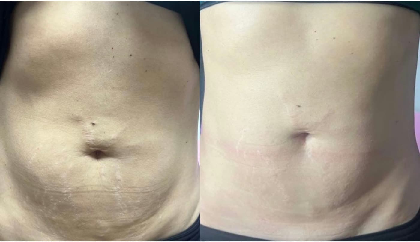Before and after Radiofrequency Body Contouring at Ora Medical Spa
