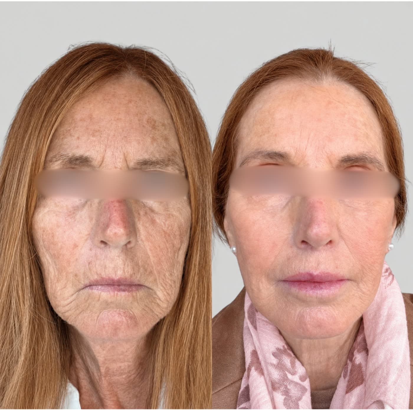 Before and after Radiofrequency Lifting Facial at Ora Medical Spa