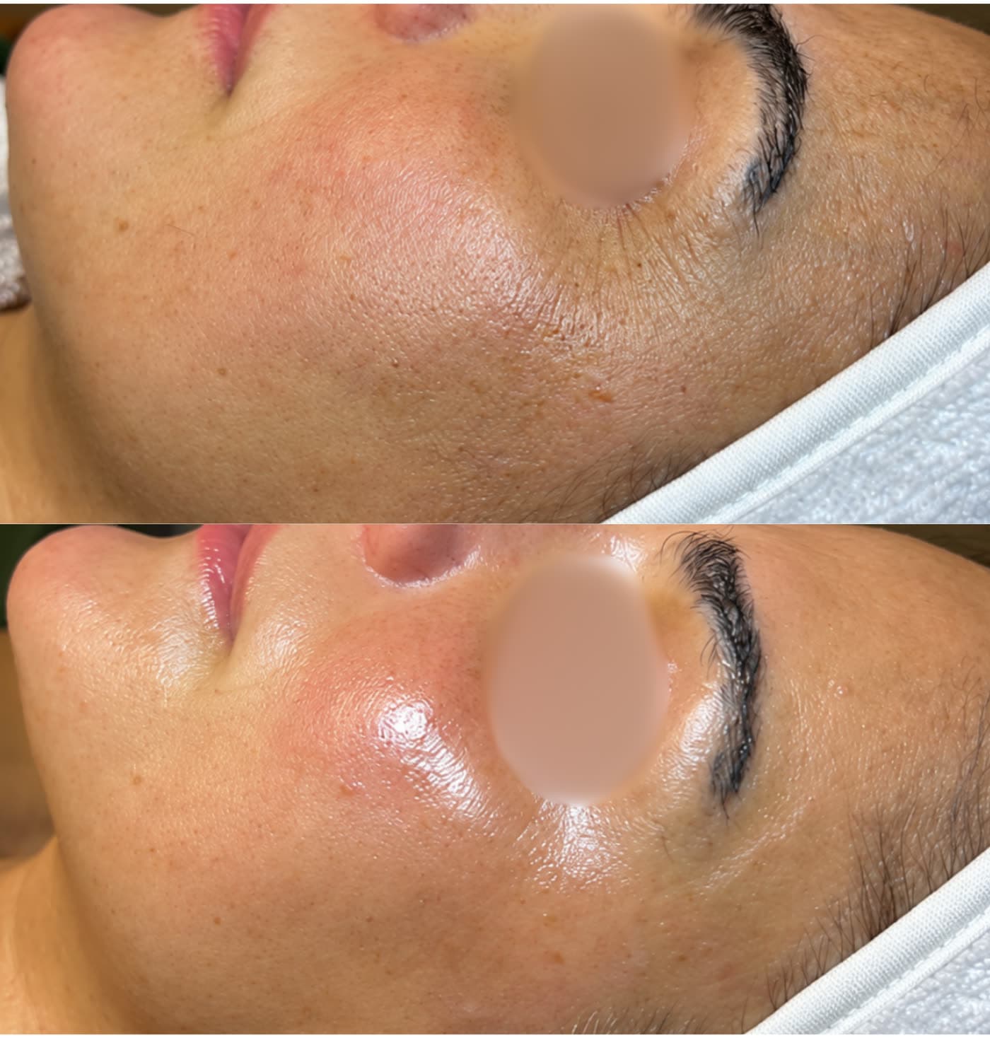 Before and after Ora Signature Facial at Ora Medical Spa